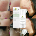 tea tree acne cream pimples remover cream